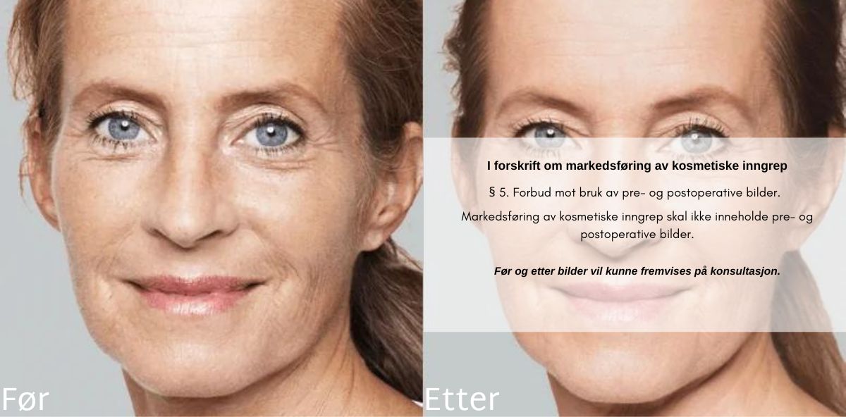 før og etter restylane skinbooster behandling