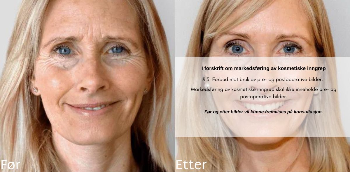 før og etter restylane skinbooster