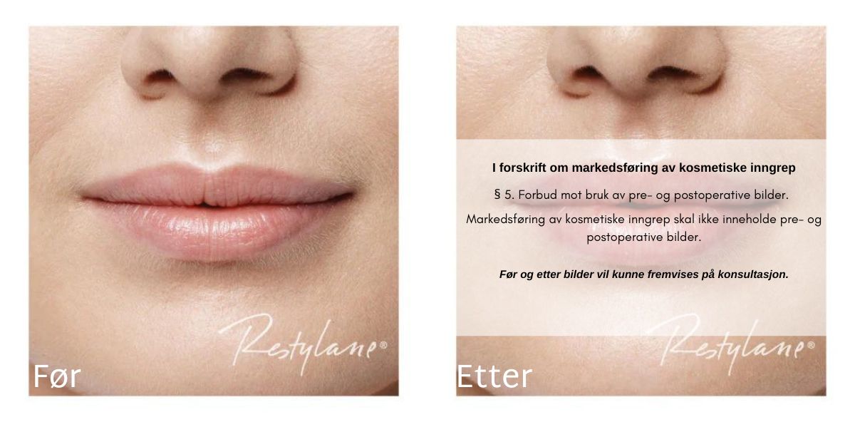 Restylane lepper Lipfillers før og etter bilder