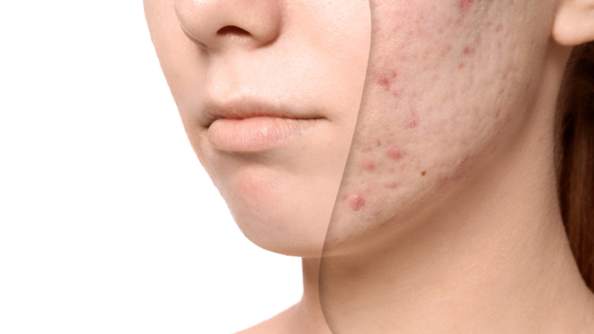 Rosacea & Acne - Laser