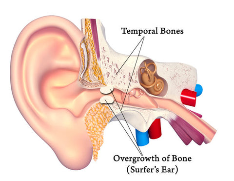 Diagram of hearing system and ear showing surfer's ear issues