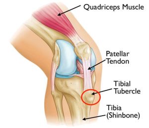 Osgood-Schlatter's Disease, one of the most common causes of knee pain in children, explained through anatomical picture