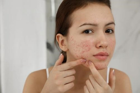 a women with acne on face and using sunscreen