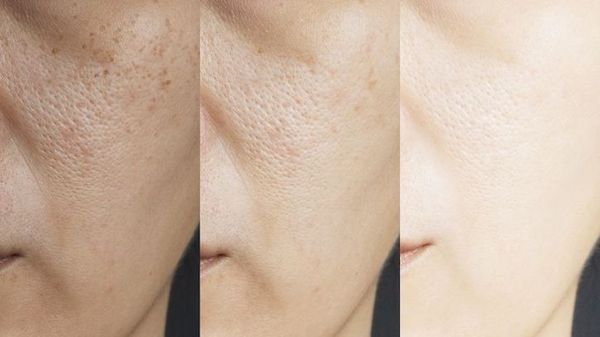 Zoomed in picture of a woman's face showing three stages of skin brightening and dark spot treatment, for our blog post on Skin Brightening and Dark Spot Treatment.