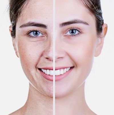 Up close picture of a woman's face before and after dark spot treatment, for our blog post on Skin Brightening and Dark Spot Treatment.