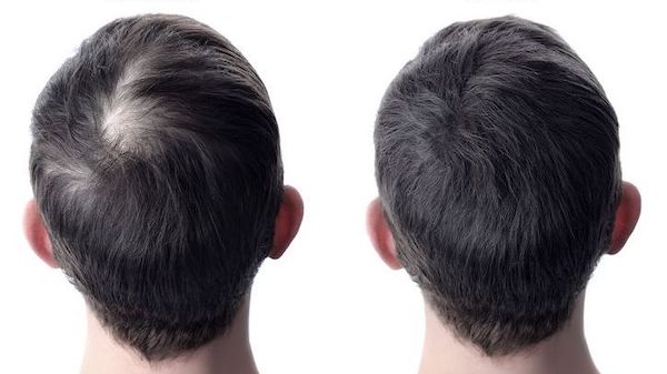 Before and after picture of showing hair regrowth at the back of a man's head, for our blog post on Nutrafol Products for Thinning Hair in Men