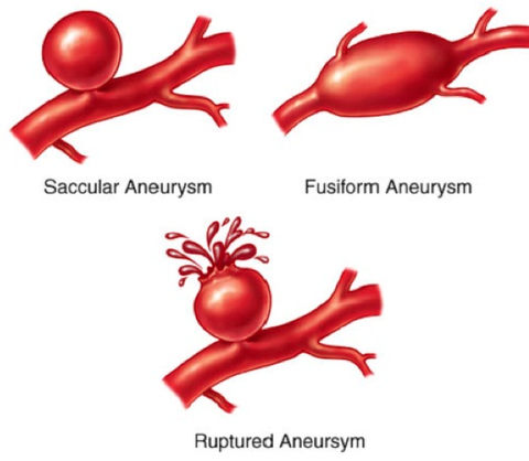 aneurysm