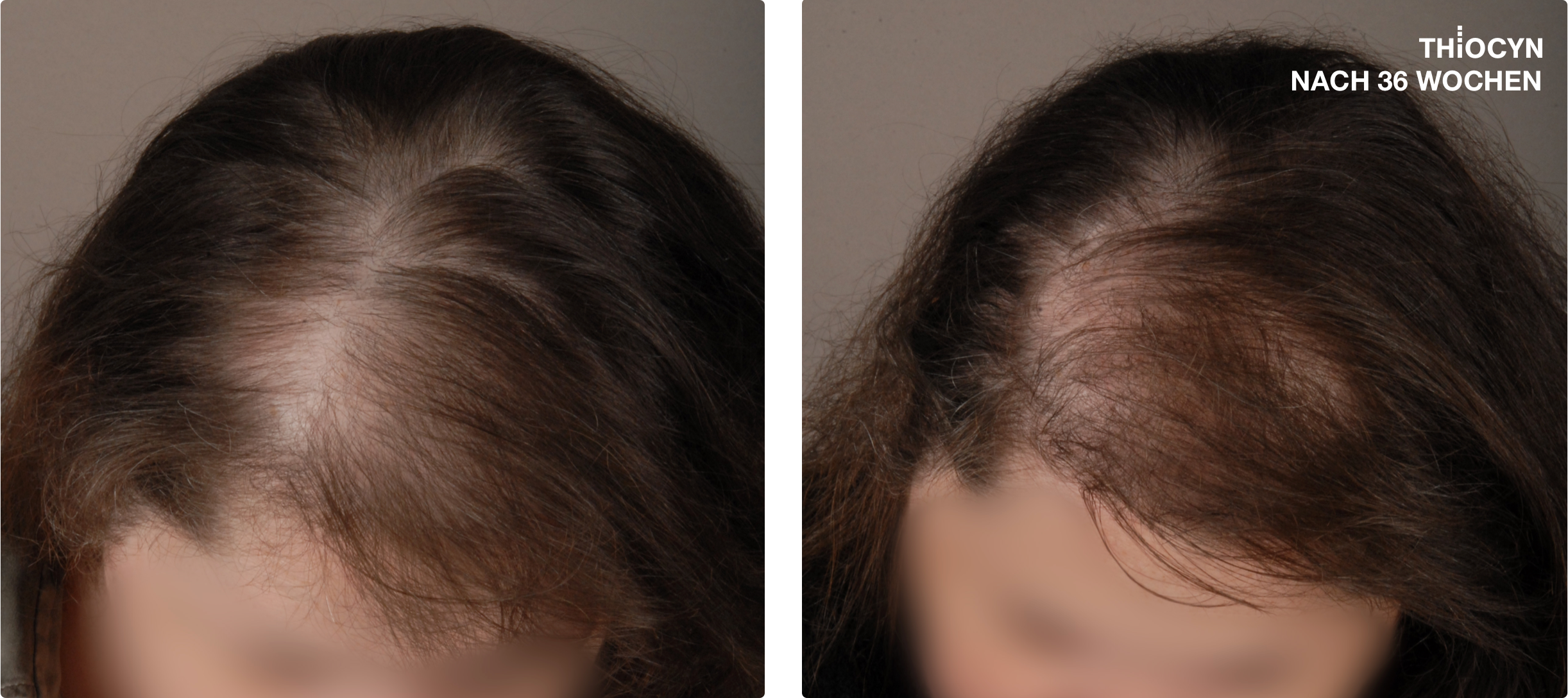 Before and after comparison of hair thickness, potentially showing results of a hair treatment product after 36 weeks.