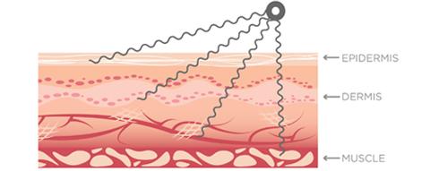 Microcurrent Therapy Image – Treatment penetrates the epidermis, dermis and muscle.