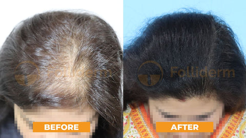 5% Biotin Minoxidil Hair Growth Oil