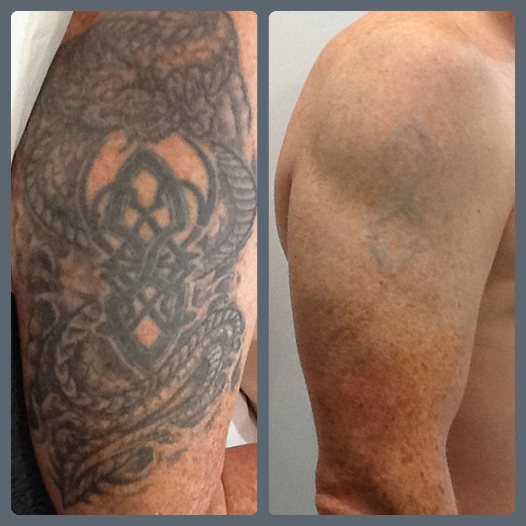 Dont DIY  Be PicoSURE when removing tattoos Skin Ink  Laser Medical  Aesthetics