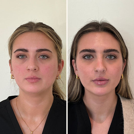 Full facial balancing before and after photo in Wilmington, NC