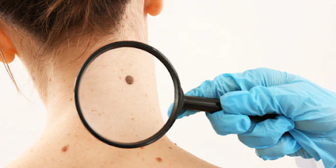 QIAWI™ Skin Tag & Mole Remover