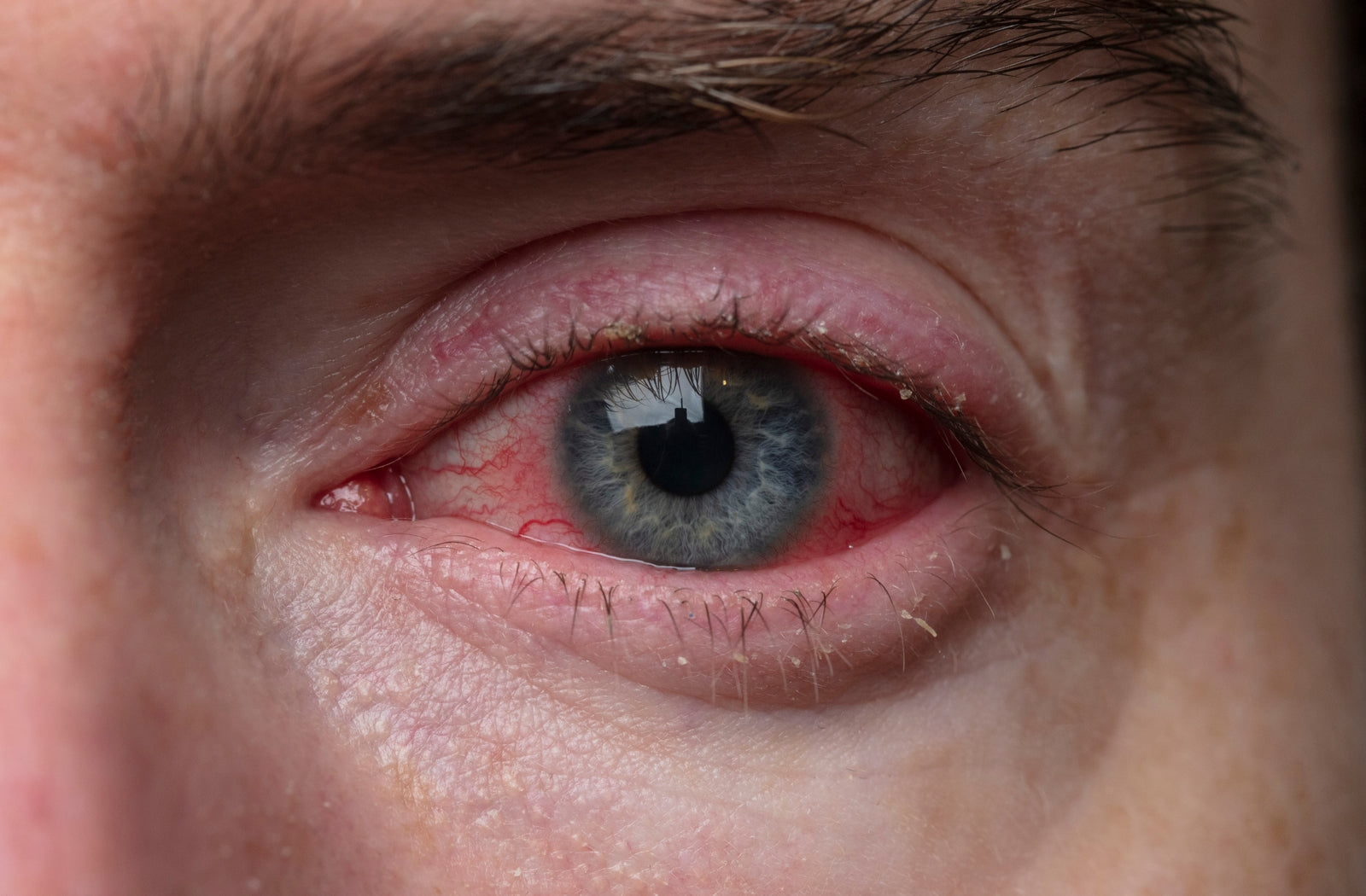 can you get pink eye from poop particles?