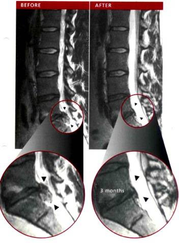 reduction in disc bulge size