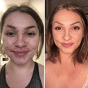 Before and after - acne edition! CCW! #makeup #beauty.jpeg__PID:f691cc7d-8ed6-4c08-9ab1-7c1e5865ddec