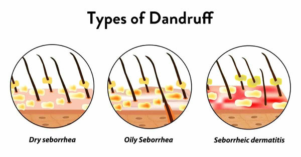 types of dandruff