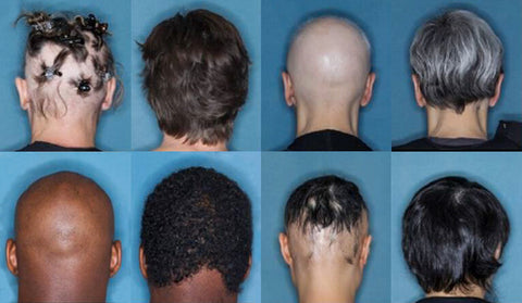 hair loss alopecia examples