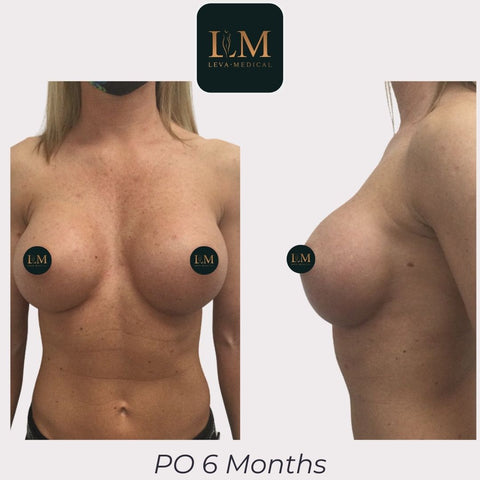 PO 6 Months Breast Augmentation