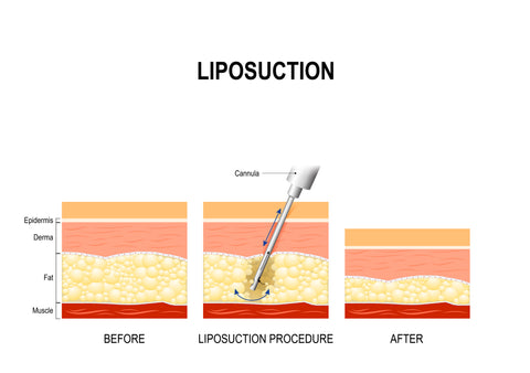 liposucción