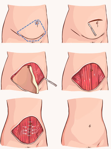 abdominoplastia