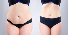 Tummy Tuck alone