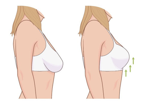 Se puede reducir el tamaño de los senos sin implantes?