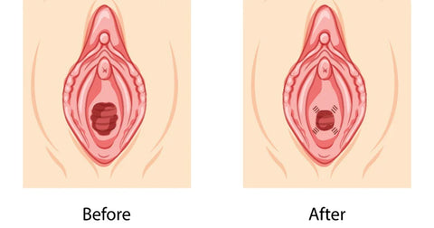 hymenoplasty before and after