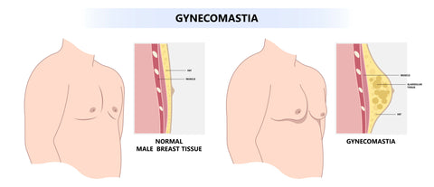 ginecomastia