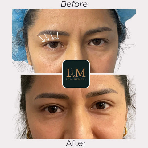 blepharoplasty before and after