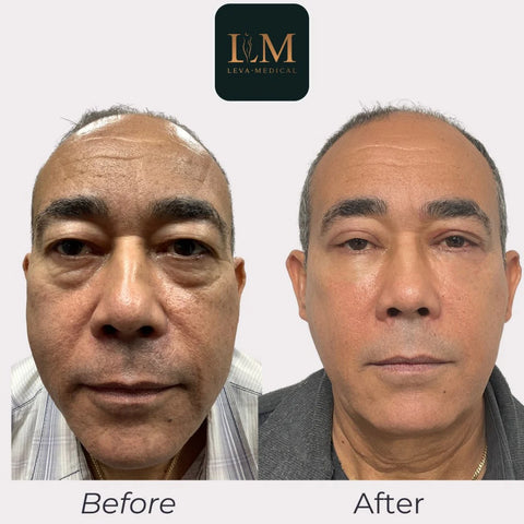 Lower Blepharoplasty