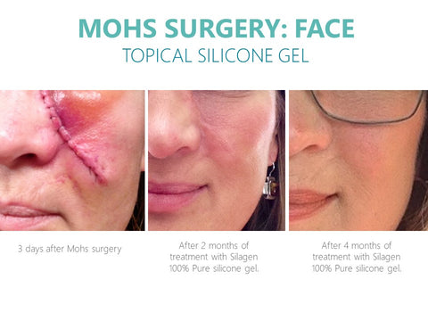 Mohs surgery 