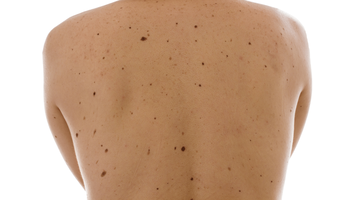 Back with multiple moles