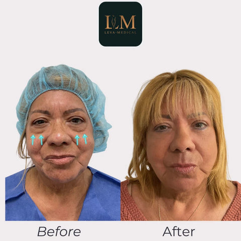 Lower Blepharoplasty