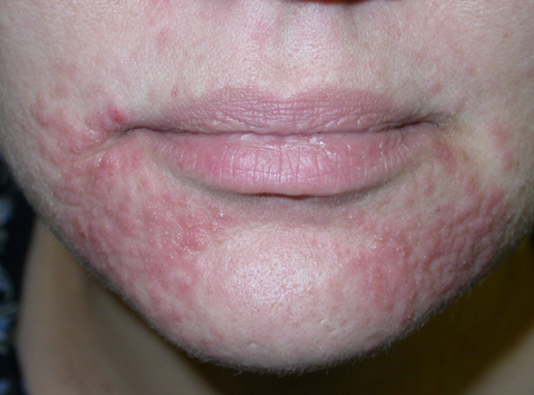 Pink rash on the mouth