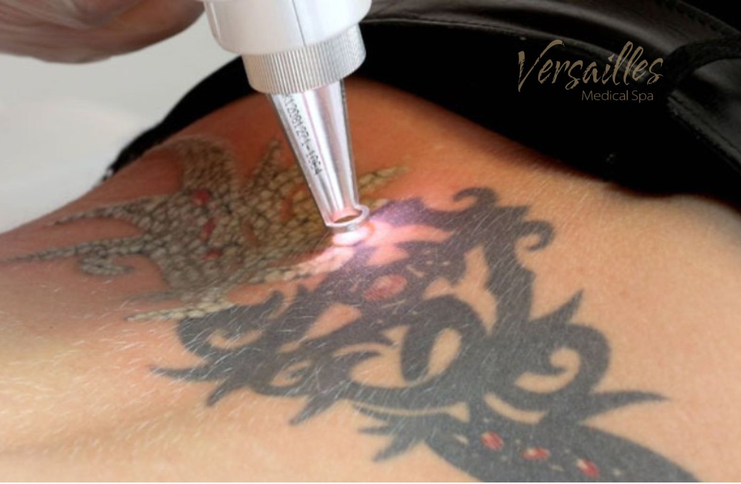 Tattoo Removal In South Windsor  West Hartford CT