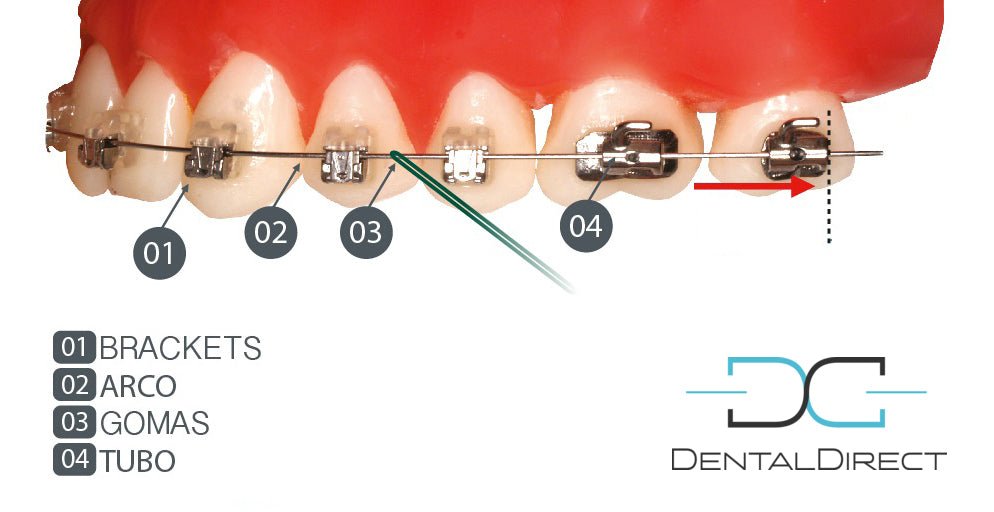 Los arcos dentales y su utilidad en ortodoncia con brackets