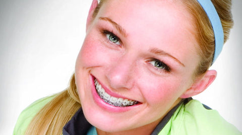arcos dentales y brackets | dentaldirect