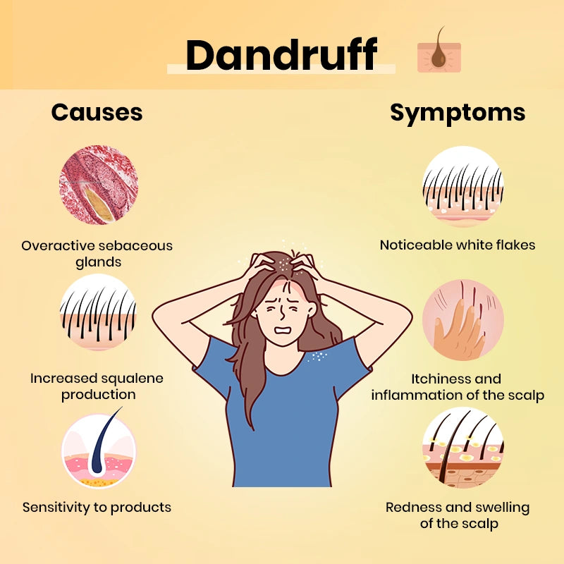 Dandruff_-_Causes_and_Symptoms