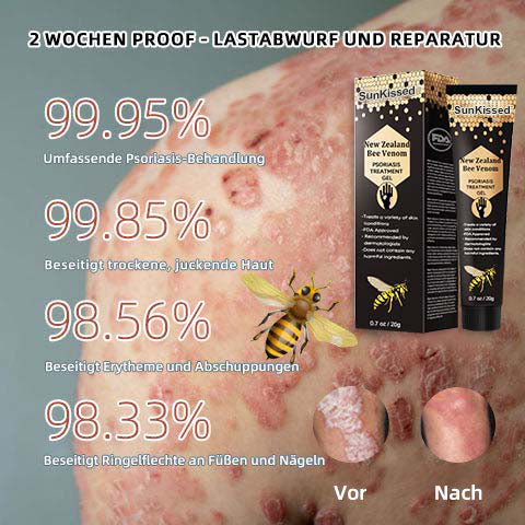 SunKissed™ New Zealand Bee Venom Psoriasis Treatment Gel