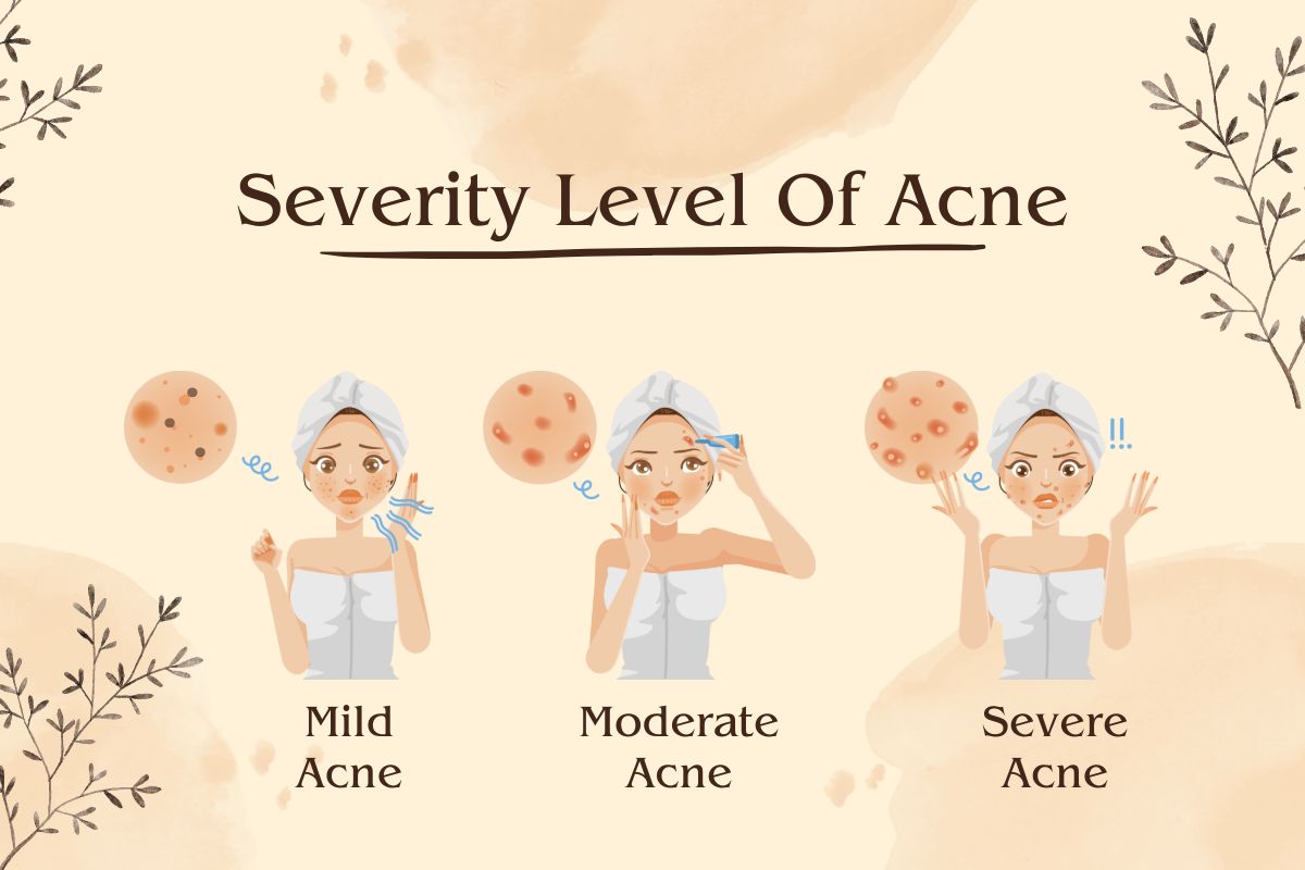 severity level of acne