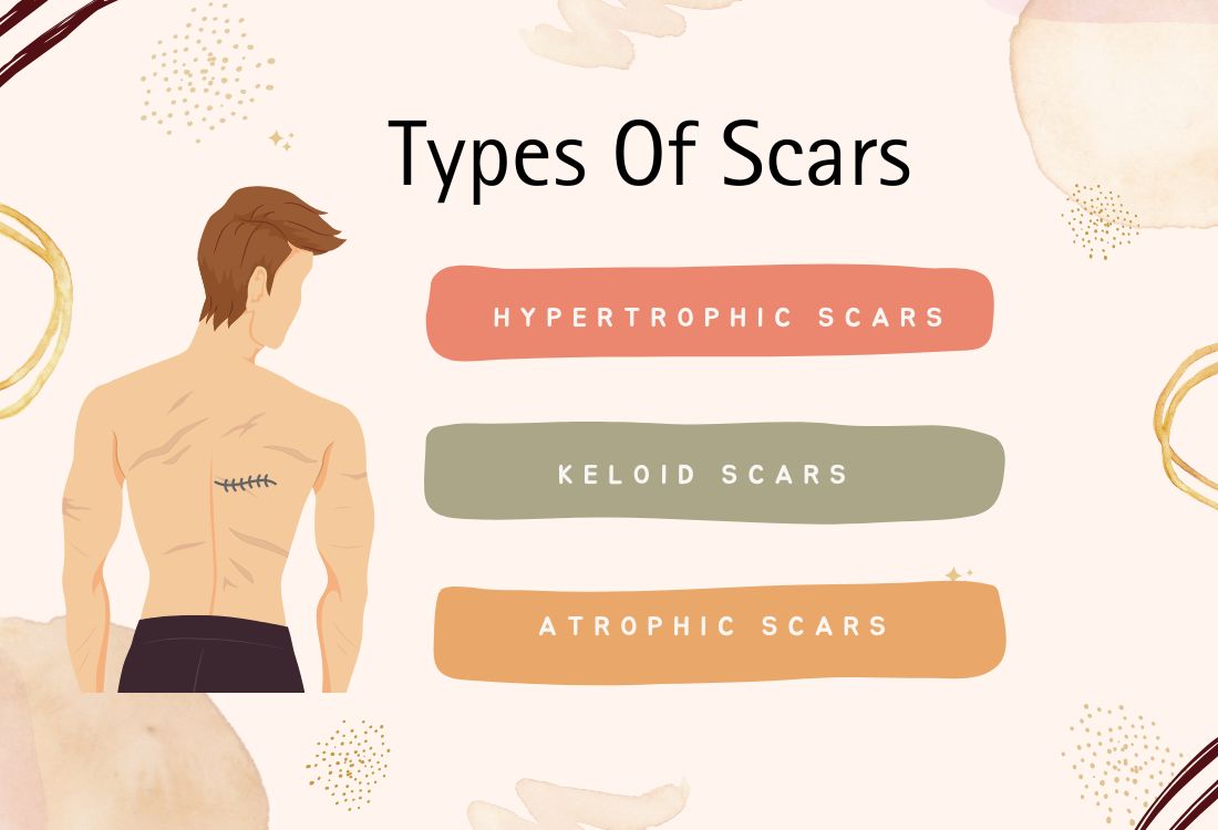 Types of scars