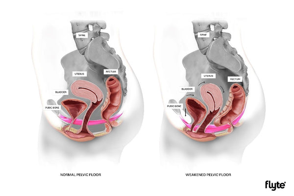 Flyte normal vs weak pelvic floor muscles