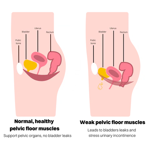 a diagram illustrating the difference between pre and post menopausal pelvic floor muscles