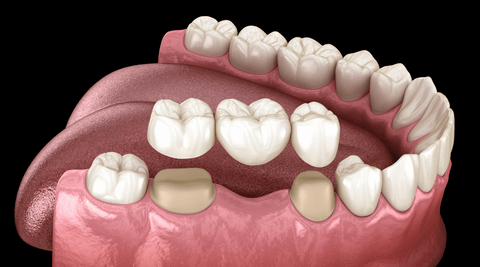 Graphic diagram of a dental bridge