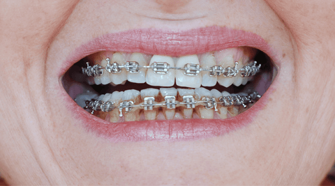 Closeup of woman's mouth with braces and severe plaque buildup between brackets
