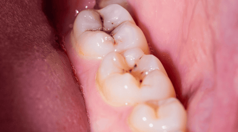 Inside of the mouth showing cavities on teeth