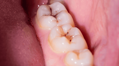 teeth with cavities and tooth decay