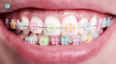 Closeup of a healthy mouth with multi-colored braces