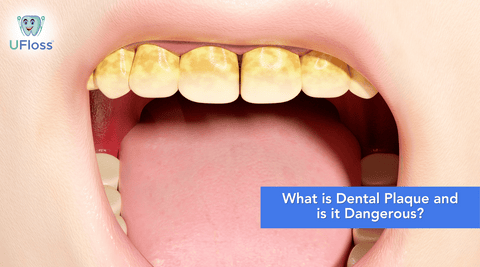 Cartoon rendering of mouth open to show teeth covered in yellow plaque